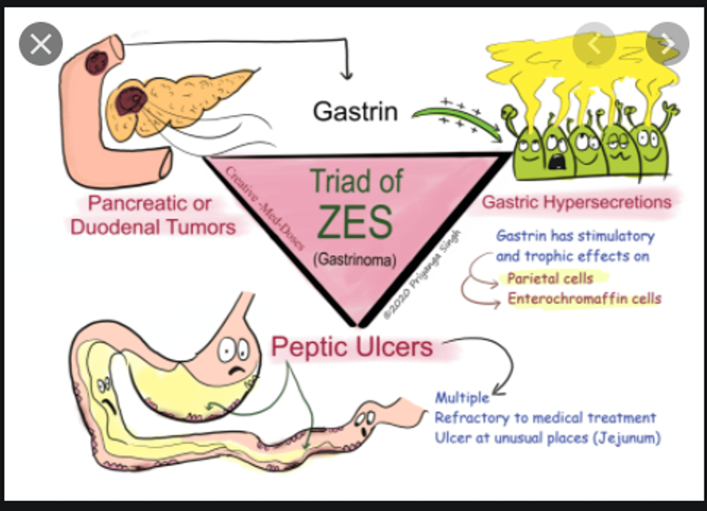 <p>Zollinger-Ellison Syndrome</p>