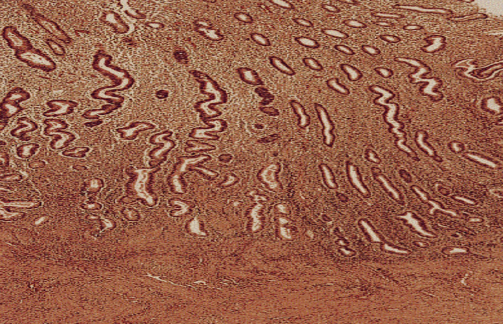 <p>Postmenopausal Endometrial Atrophy</p>