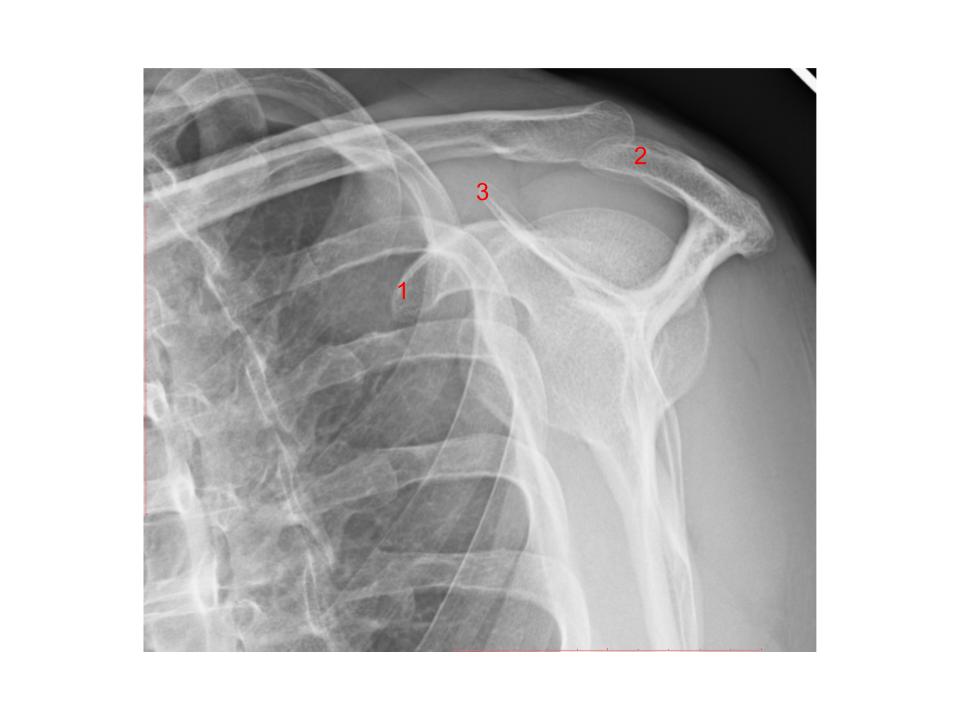 <p>What structure is #2?</p><p>A. Coracoid process</p><p>B. AC joint</p><p>C. Acromion process</p><p>D. Clavicle</p>