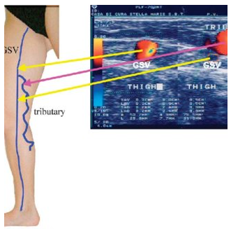 <p>Tributary is a superficial vein. </p>