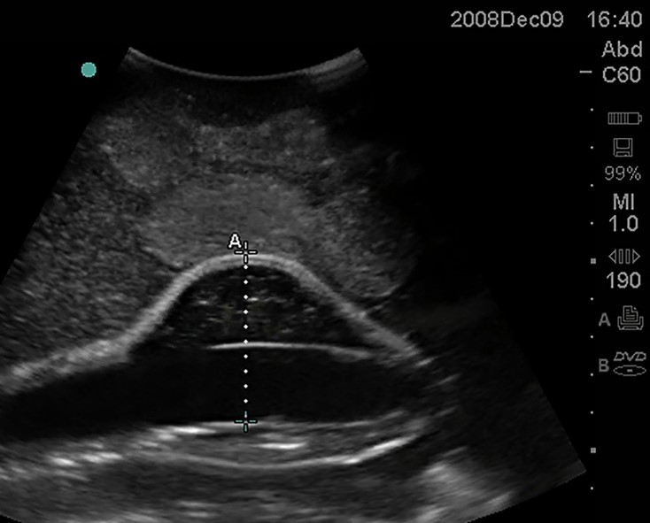 <p>What is starting to from in this Aorta?</p>