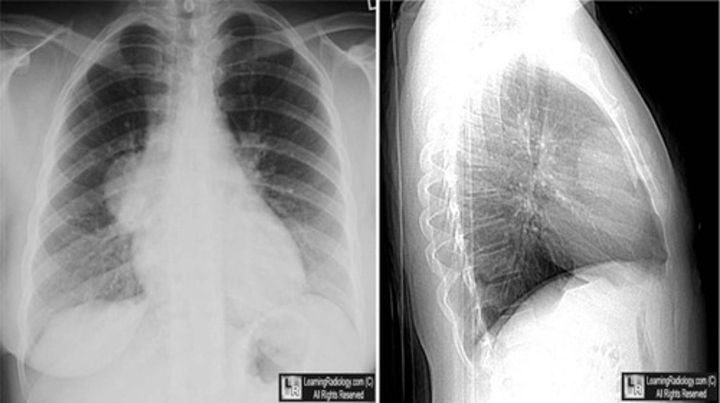 <p>-substernal thyroid mass</p><p>-lymphoma</p><p>-thymoma</p><p>-teratoma</p>