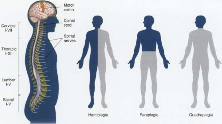 <p>when the condition affects the lower half of the body</p>