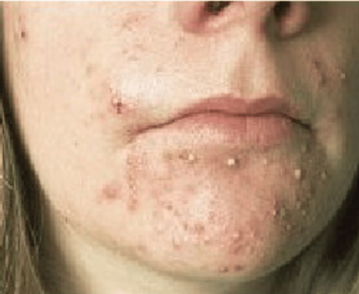 <p>= zichtbare holte gevuld met purulent vocht, zonder eigen wand, &lt; 1 cm, meestal in de epidermis gelegen.</p>