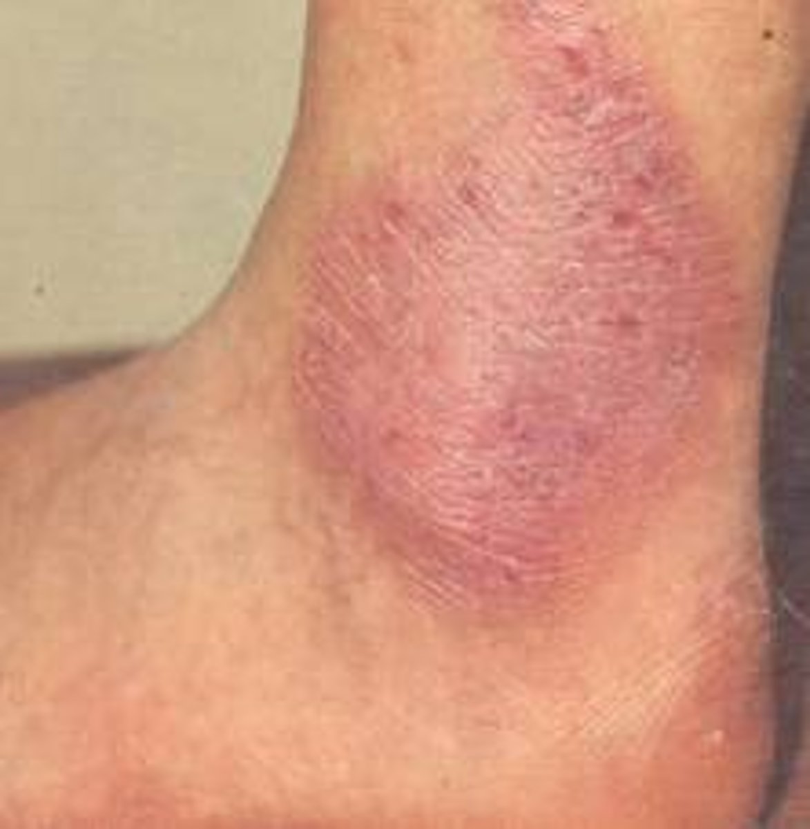 <p>diagnose this image</p><p>Thick, well- circumscribed plaques that are HIGHLY pruritic (hard to break itch-scratch cycle)</p>