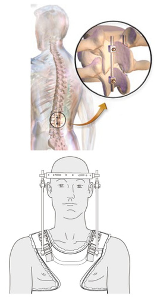 <p>false - only surgical intervention (HALO is the closest we come, but still not true distraction)</p>