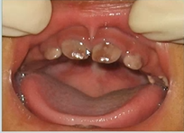 <p>abnormal colour of teeth - what causes purple/red teeth?</p>