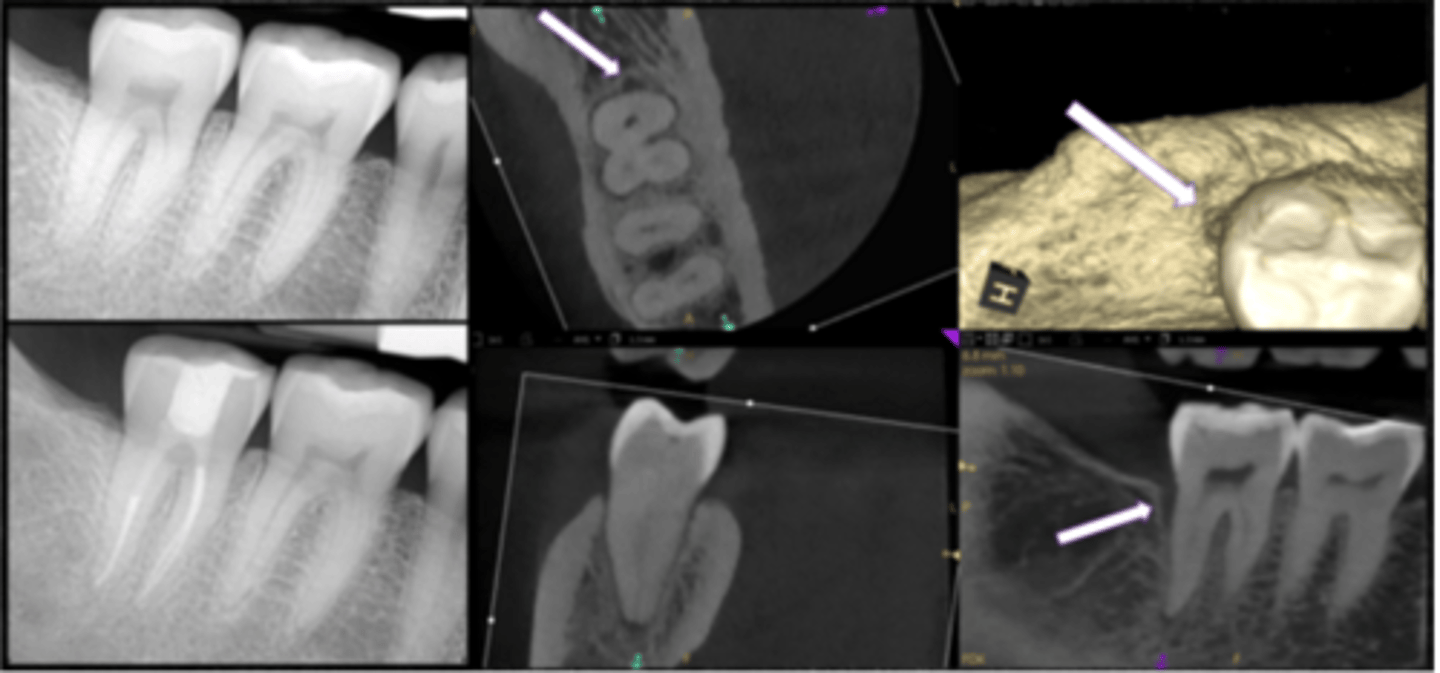 <p>What type of lesion?</p><p>- Tooth #31 with shallow restoration. Crack developed extending through distal marginal ridge and onto distal surface</p><p>- Isolated, narrow area of bone loss develops adjacent to crack (see white arrows)</p><p>- Pulpal dx: pulp necrosis; Periapical dx: symptomatic apical periodontitis</p><p>- Recent study showed favorable longterm prognosis in cracked teeth after RCT, deep intraorifice barriers, occlusal adjustment, and immediate crown</p>