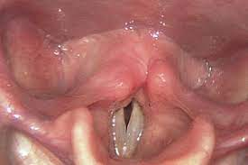 <ul><li><p>functional voice disorder</p></li><li><p>excessive muscle tension</p></li></ul>