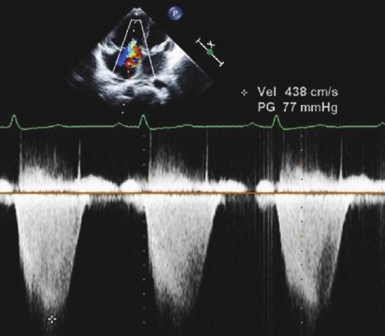 <p>Identify the spectral Doppler waveform:</p>