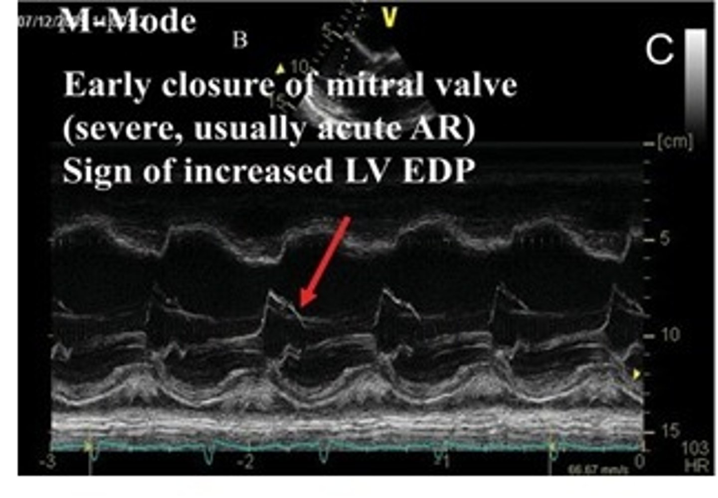 <p>early closure of MV; severe cases will be AR(AI) and increased LVEDP</p>