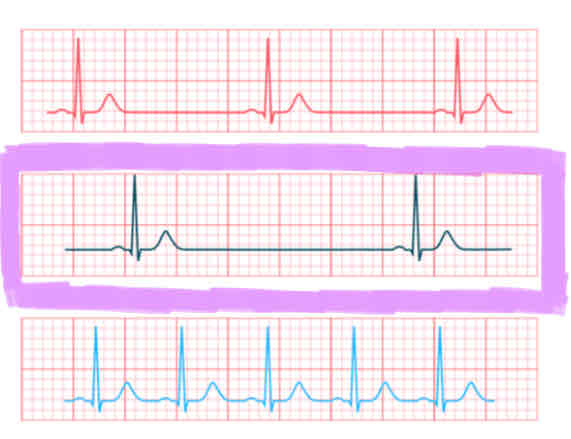 <p><span>the heart is pumping too slow</span></p><ul><li><p><span>a heart rate of &lt;60 BPM</span></p></li></ul><p></p>