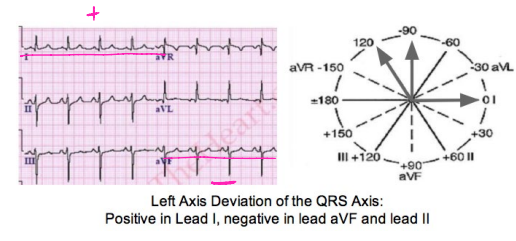 <p><strong>Left Axis Deviation</strong></p><p>-The QRS complex is ________ in Lead I and ________ in aVF</p>