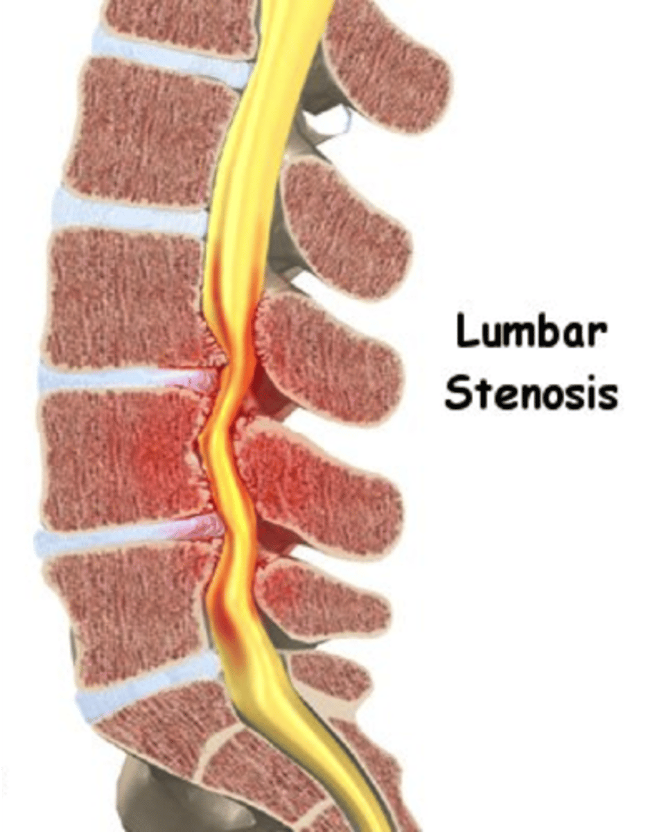 <p>narrowing of the spinal column</p>