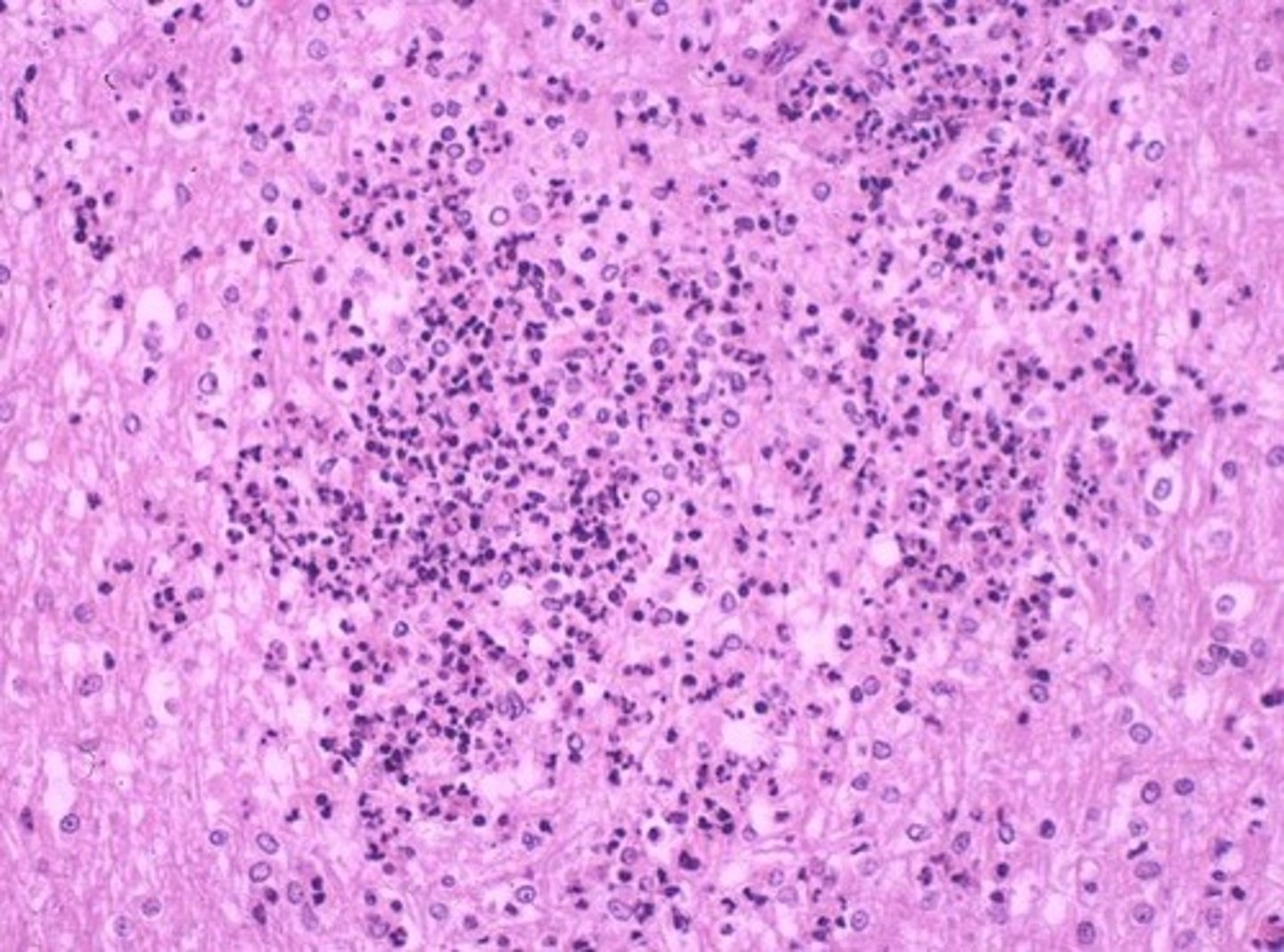 <p>1. Usually foodborne but meningitis more common in the immunocompromised individuals</p><p>2. Can invade the bloodstream, causing sepsis</p><p>3. Reproduces in phagocytes (Spreads phagocyte-to-phagocyte)</p><p>4. Infects pregnant women, crossing the placenta and leading to stillbirth</p>