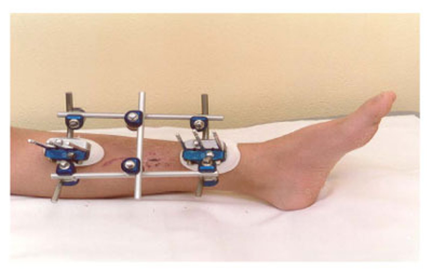 <p>use of external fracture-stabilizing device permits bone healing</p>