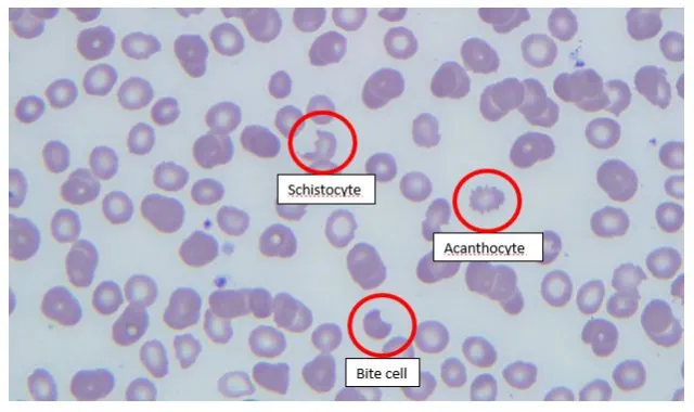 <p>spurr cells rbc (acanthocyte)</p>