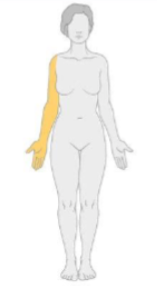 <p>what type of neuropathy would have the following distribution?&nbsp;</p>