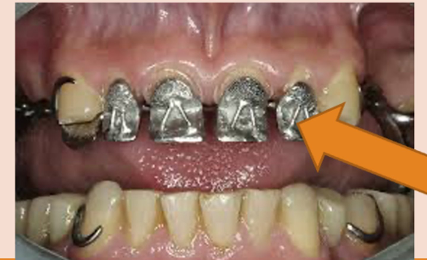 <p>hold denture tooth "veneer" (occluding surface is part of metal framework)</p>