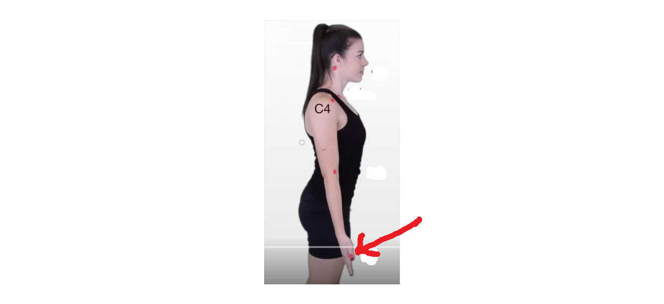 <p>The dermatomal area where the arrow is pointing would indicate what level? </p>