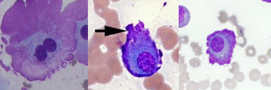 <p>A. Identify the abnormality / cell</p><p>B. This is seen in what condition / disease</p>