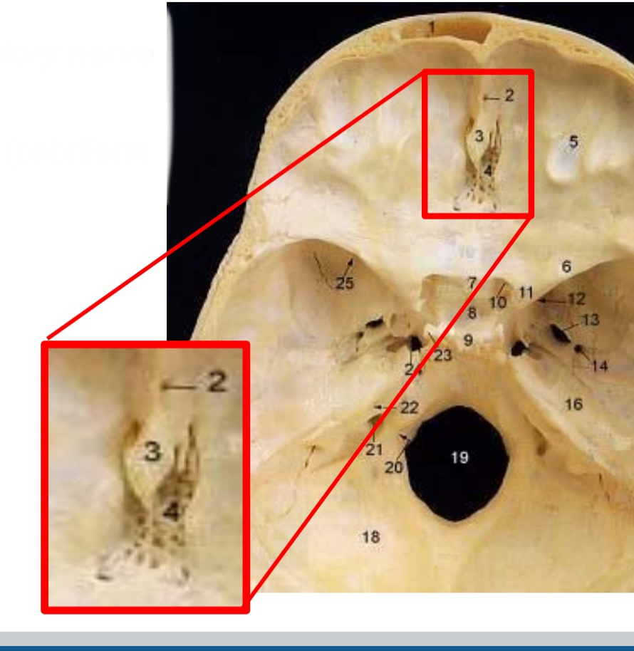 <ul><li><p>Damage like electric razor (like shaving the olfactory nerve)</p><ul><li><p>Head trauma (cribriform plate)</p></li><li><p>Infections → swelling of the nerve</p></li></ul></li></ul><p></p>
