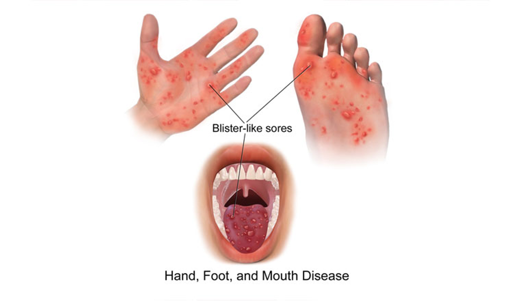 <p>Physical exam Hand-Foot-Mouth Disease (HFMD)</p>