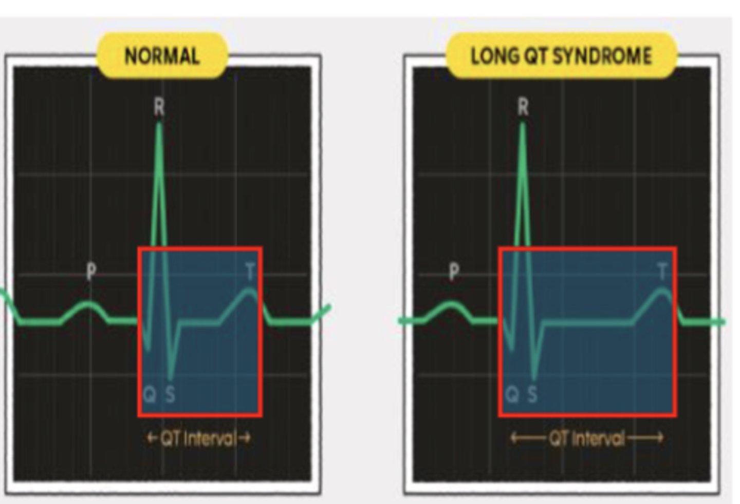 <p>a potentially life-threatening arrhythmia called torsades de pointes (pronounced torsad de pwant)</p>