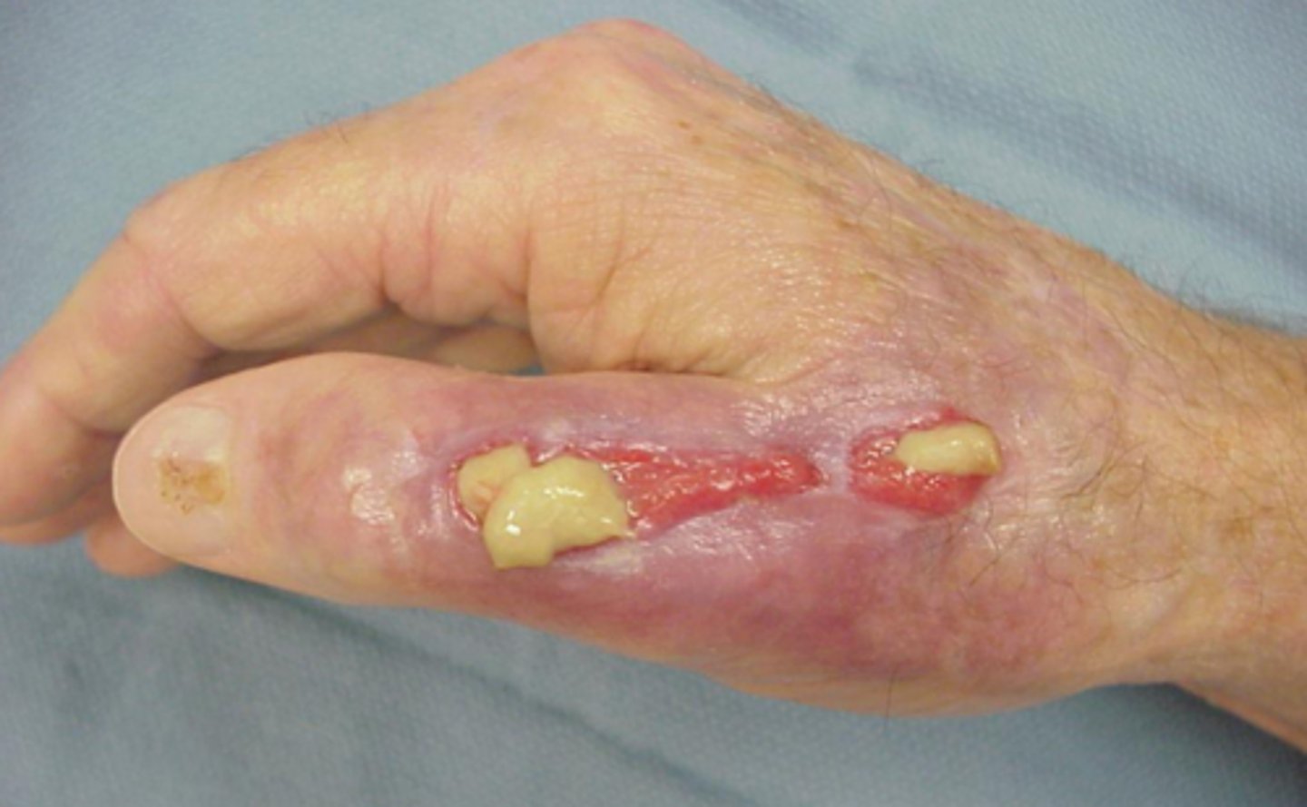 <p>AKA pus, microbe and WBC involvement, thick and whitish/yellowish</p>