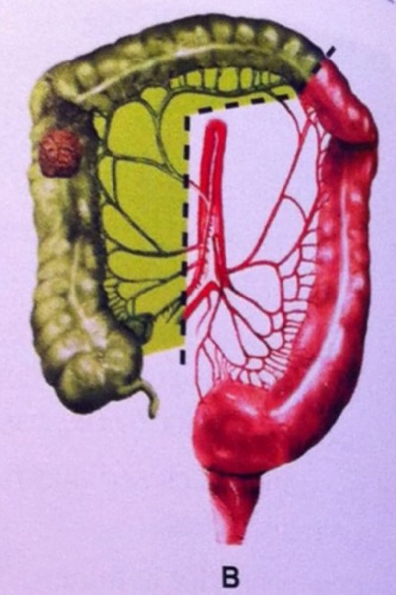 <p>Excision of half of the colon (not gallbladder)</p>