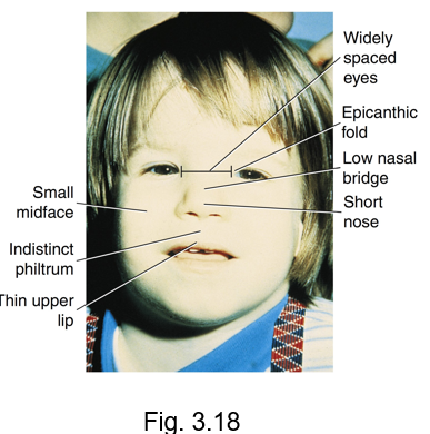 <ul><li><p>presents with noted orofacial features and various levels of intellectual disability</p></li><li><p>cause by the pregnant woman’s excessive use of ethanol during the embryonic period</p></li><li><p>characterized by </p><ul><li><p>small midface</p></li><li><p>indistinct philtrum</p></li><li><p>thin upper lip</p></li><li><p>widely spaced eyes</p></li><li><p>epicanthic fold</p></li><li><p>low nasal bridge</p></li><li><p>short nose </p></li></ul></li></ul><p></p>