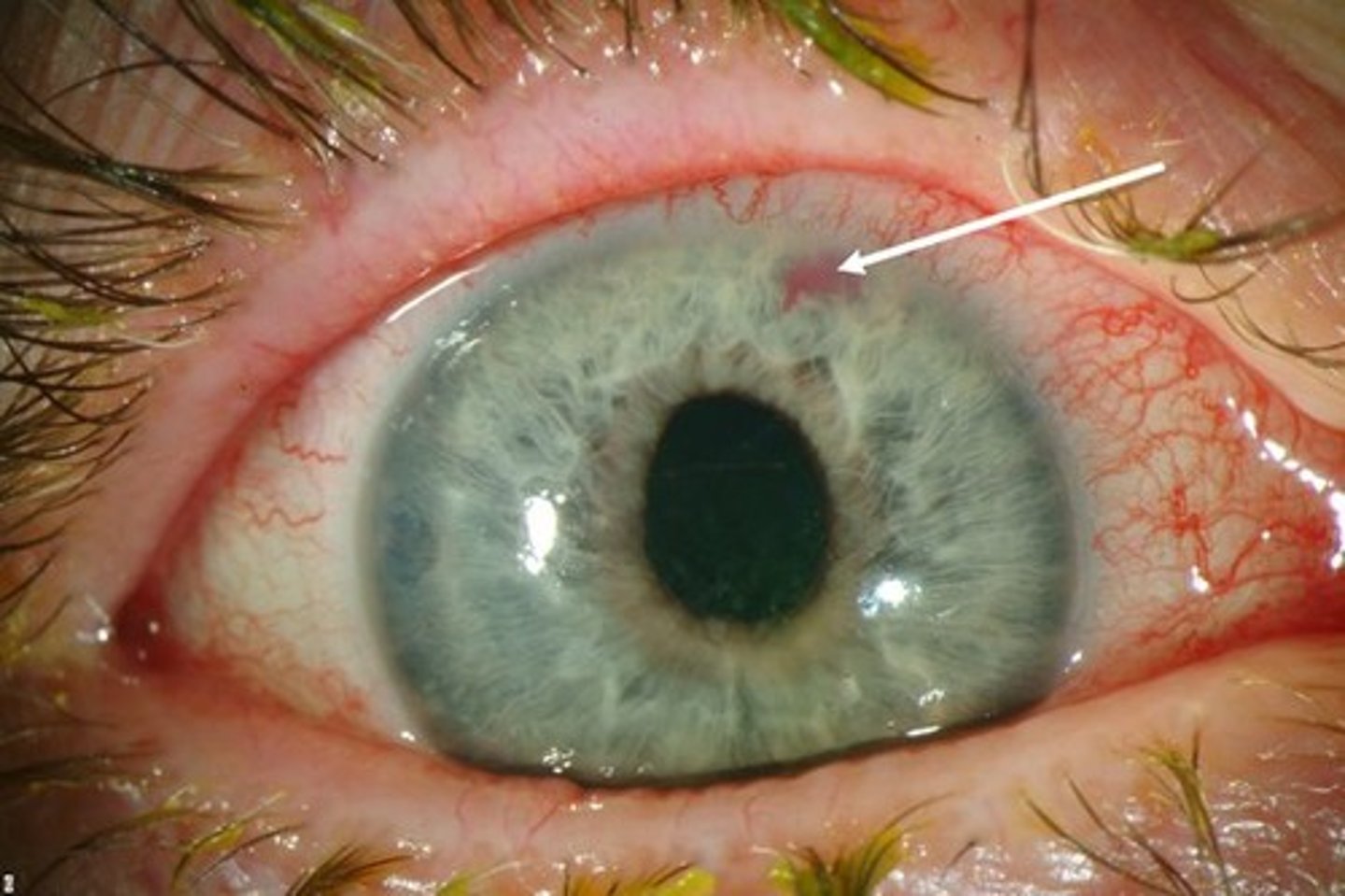 <p>Pt describes a change in vision, the loss of peripheral vision</p>