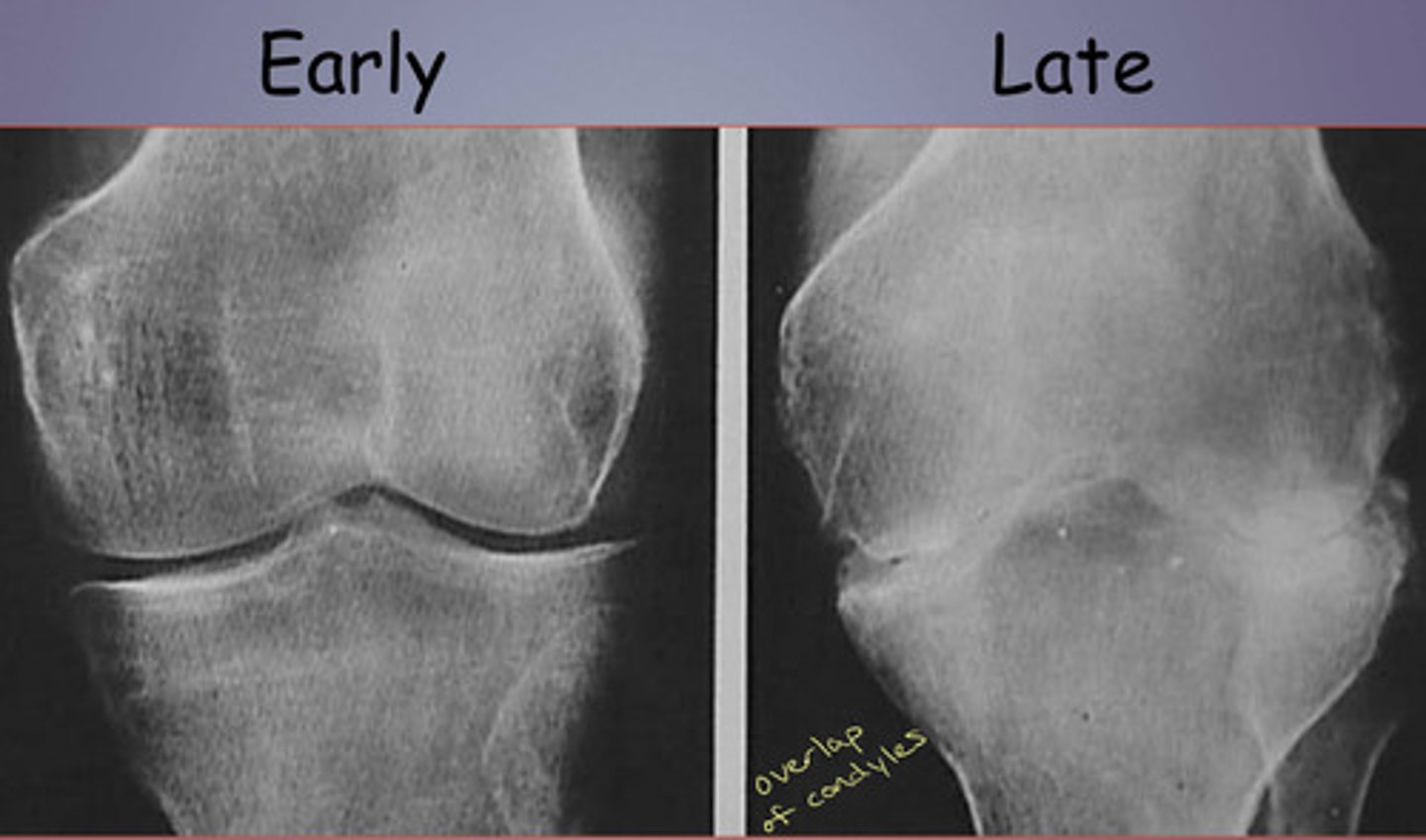 <p>Symmetric loss of joint space (vs osteoarthrosis = more at medial side)</p><p>Erosions and Baker Cyst</p>