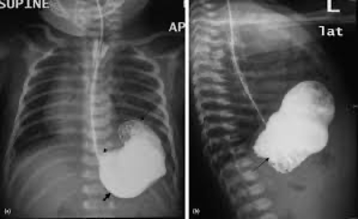 <p>Infants</p><p>Best seen on US- thickened pyloric muscle</p><p>GI also- filling defect at antrum and delayed gastric emptying</p>