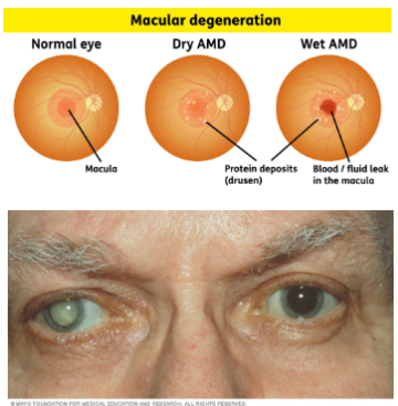 <ul><li><p>over 60 years there is sensory decline leading to impaired taste and smell</p></li><li><p>a decrease in the amount of saliva also contributes to this decreased sense</p></li><li><p>thirst sense decreased (increased risk of dehydration)</p></li><li><p>decreased visual acuity makes shopping and food preparation more difficult</p></li></ul><p></p>