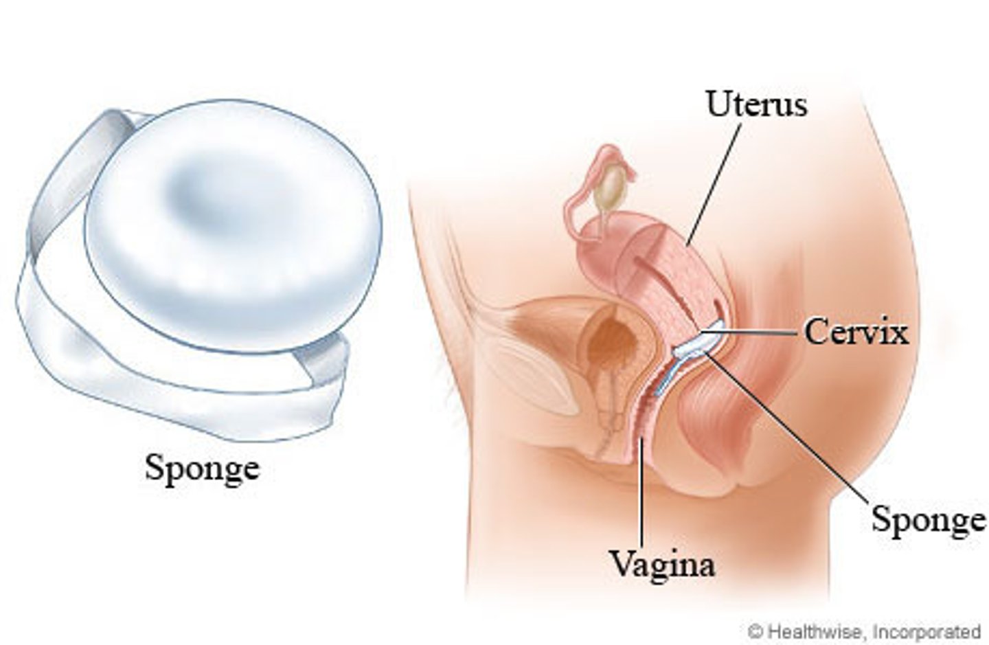 <p>A sponge structure similar to cervical cap</p><p>-Non-hormonal</p>