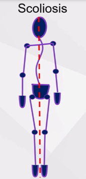 <p>S shaped curve in spine, caused by uneven shoulder levels which can accomodate for uneven pelvis</p>