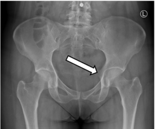 <p>Identify the anatomical structure being pointed by the white arrow.</p><p>A. Iliopectineal line</p><p>B. Anterior superior iliac spine</p><p>C. Ischial tuberosity</p><p>D. Posterior inferior iliac spine</p><p>E. Ischial spine</p>