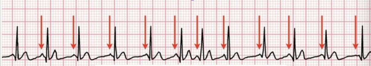<p>pacemaker site shifts → at least 3 different P wave morphologies ; HR &gt; 100</p>