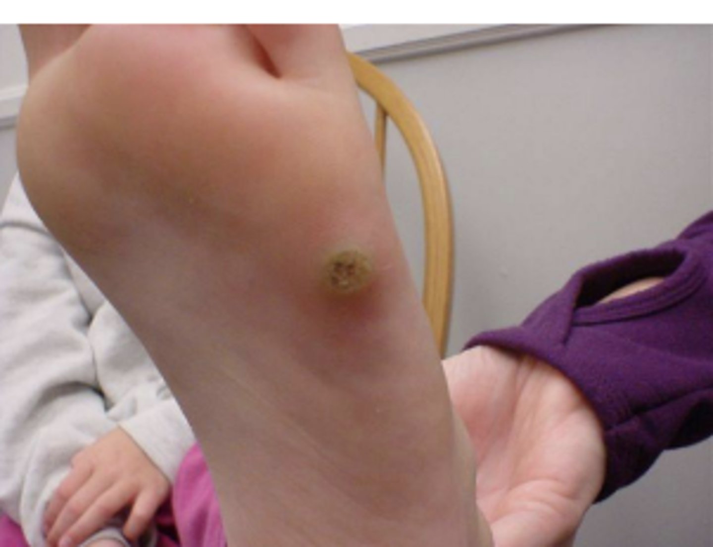 <p>benign viral infections of skin caused by HPV</p>