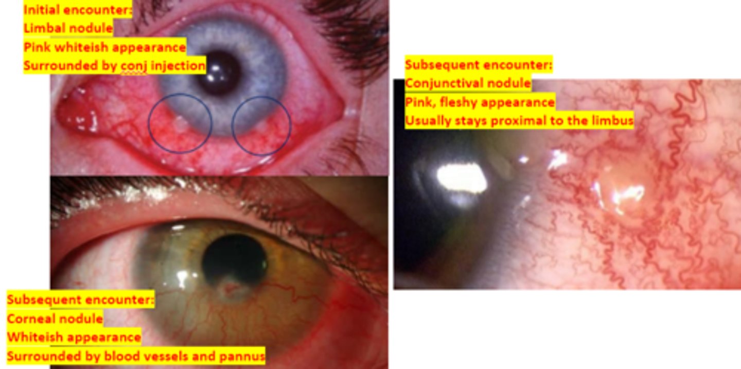 <p>a local conjunctival/corneal type IV hypersensitivity reaction to a bacterial antigen requiring repeat exposure to that specific antigen. Was previously associated with TB (more symptomatic), but is now more common with staph. Is more common in children. Involves that formation of subepithelial nodules of inflammatory cells. Initial encounter will affect the limbus and subsequent encounter migrate to the cornea and conjunctiva. If the cornea is affected, the reaction tends to be more severe – pain, photophobia, blepharospasm. Culturing of the organism is important. Management includes steroids AND antibiotics.</p>