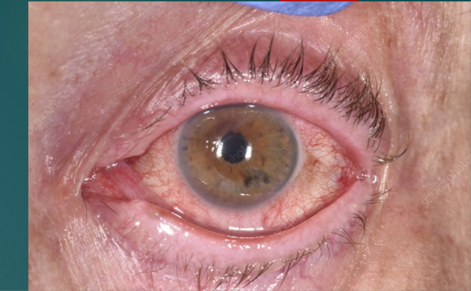 <p>Very common!</p><p>Scraping away of corneal surface from external forces</p><p>Cornea and bulbar conjunctiva are affected</p><p>Minor or superficial abrasions involve only corneal epithelium</p><p>Severe injuries involve deeper, thicker stromal layer</p>