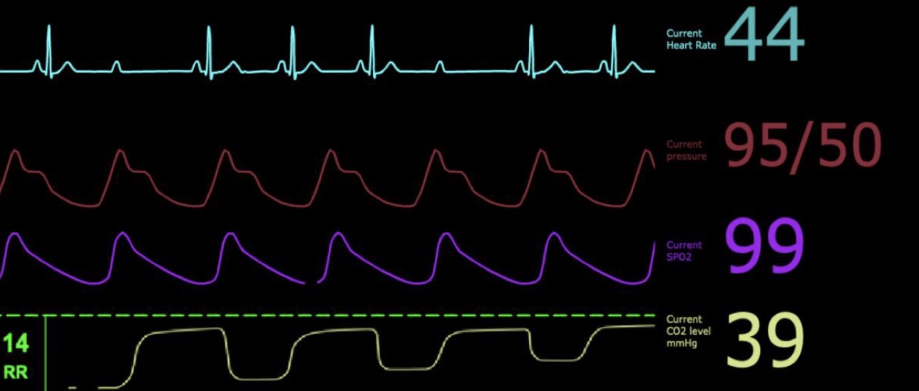 <p>What type of arrhythmia is demonstrated in this case?</p>