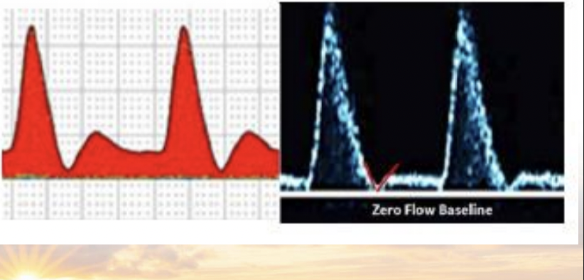 <p>Describe an intermediate resistive waveform </p>
