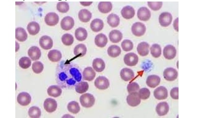 <p><span style="font-family: Helvetica; font-size: 12px;">Which of the following diseases is an autosomal dominant disorder characterized by these pale blue inclusions and platelet morphology?</span></p>