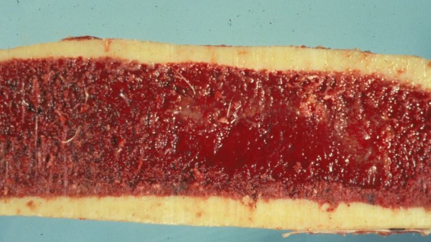 <p>This photograph shows a longitudinal section of the mid-shaft femur from an adult dog that has a two-month history of anemia before its death. ITs white blood cell numbers and morphology were all within normal limits. Which of the following is the most likely explanation for the gross appearance of this dog’s bone marrow? </p>