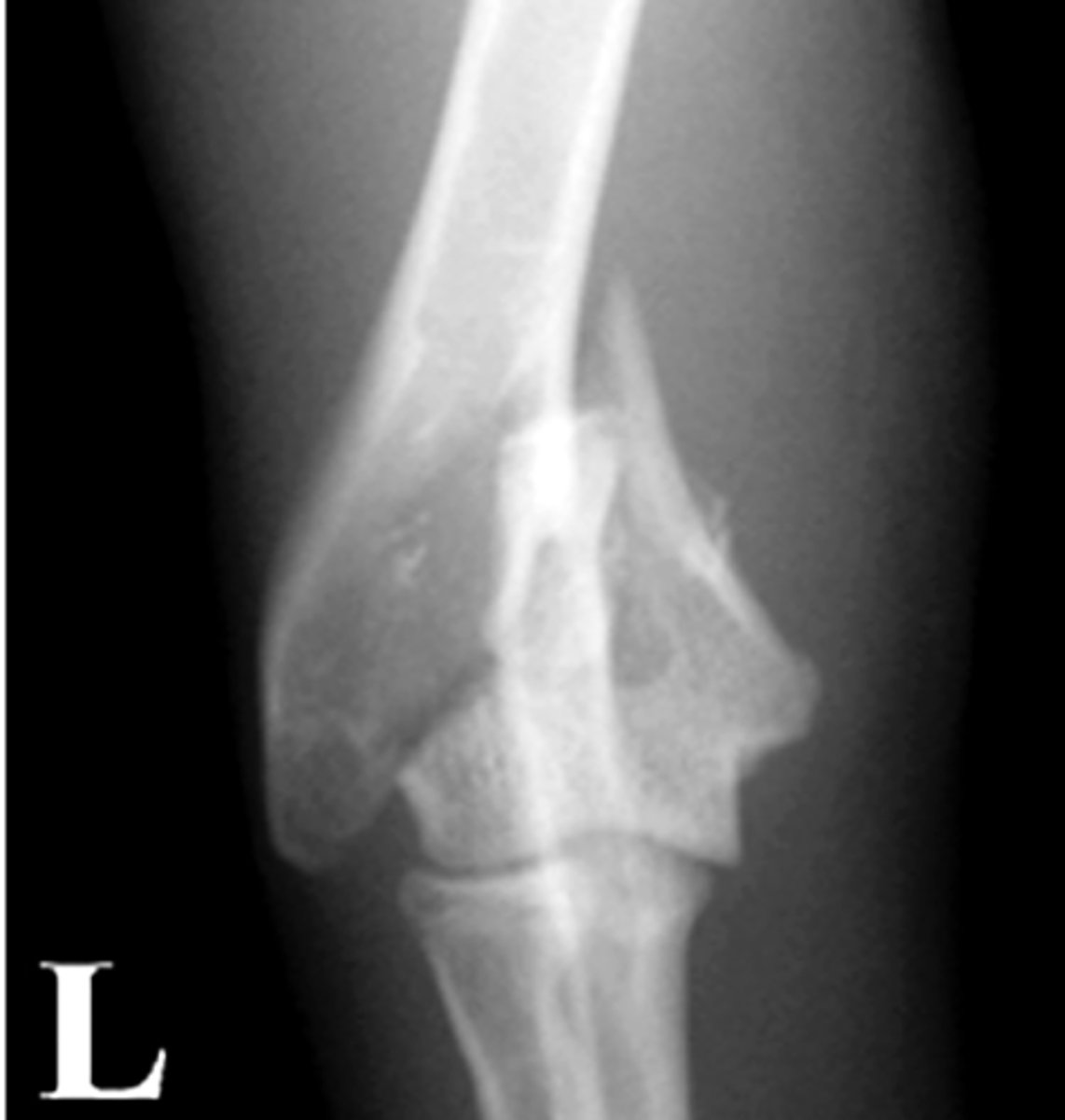 <p>Identify the fracture type?</p>