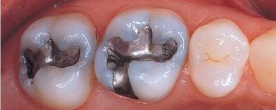 <p>-silver-tin-copper alloys are amalgamated with mercury</p><p>-amalgam has been used as a direct restorative material in the US for over 150 years</p><p>-benefits of amalgam as a direct restorative material: cost-effective, less technique sensitive, more moisture tolerant than composite</p>