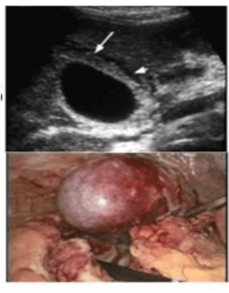 <p>Define Cholelithiasis Complication:</p><p>Stones in cystic duct causing bile obstruction</p><p>-Hx: </p><p>&gt; 90% of Acute Cholecystitis</p><p>&gt; MC Major complication of Gallstones</p><p>-Path:</p><p>&gt; Gallbladder squeezes --&gt; constricts blood supply (ischemia)</p><p>&gt; Bile stasis --&gt; release of inflammatory enzymes --&gt; damages gallbladder mucosa ==&gt; Chemical irritation of gallbladder epithelium</p><p>&gt; Distended gallbladder wall ---&gt; Release PGs ==&gt; Inflammation</p><p>-Sx/PE:</p><p>&gt; RUQ Pain (radiates to right scapula)</p><p>&gt; (+) Murphy's Sign (inspiratory arrest on RUQ Palpation d/t pain)</p><p>&gt; Fever</p><p>&gt; Nausea</p><p>&gt; Vomiting</p><p>-Dx:</p><p>&gt; Gross:</p><p>&gt;&gt; Distension/edema of gallbladder</p><p>&gt;&gt; Bright red/blotchy, bluish-purple color (subserosal hemorrhage)</p><p>&gt; Thickened gallbladder wall</p><p>&gt; Biopsy:</p><p>&gt; Acute inflammation (Neutrophils)</p><p>&gt; Edema</p><p>&gt; Mucosal erosion and hemorrhage</p><p>-Tx: Most Frequent indication of EMERGENT CHOLECYSTECTOMY</p><p>-Prog: If left untreated = RISK OF RUPTURE</p>
