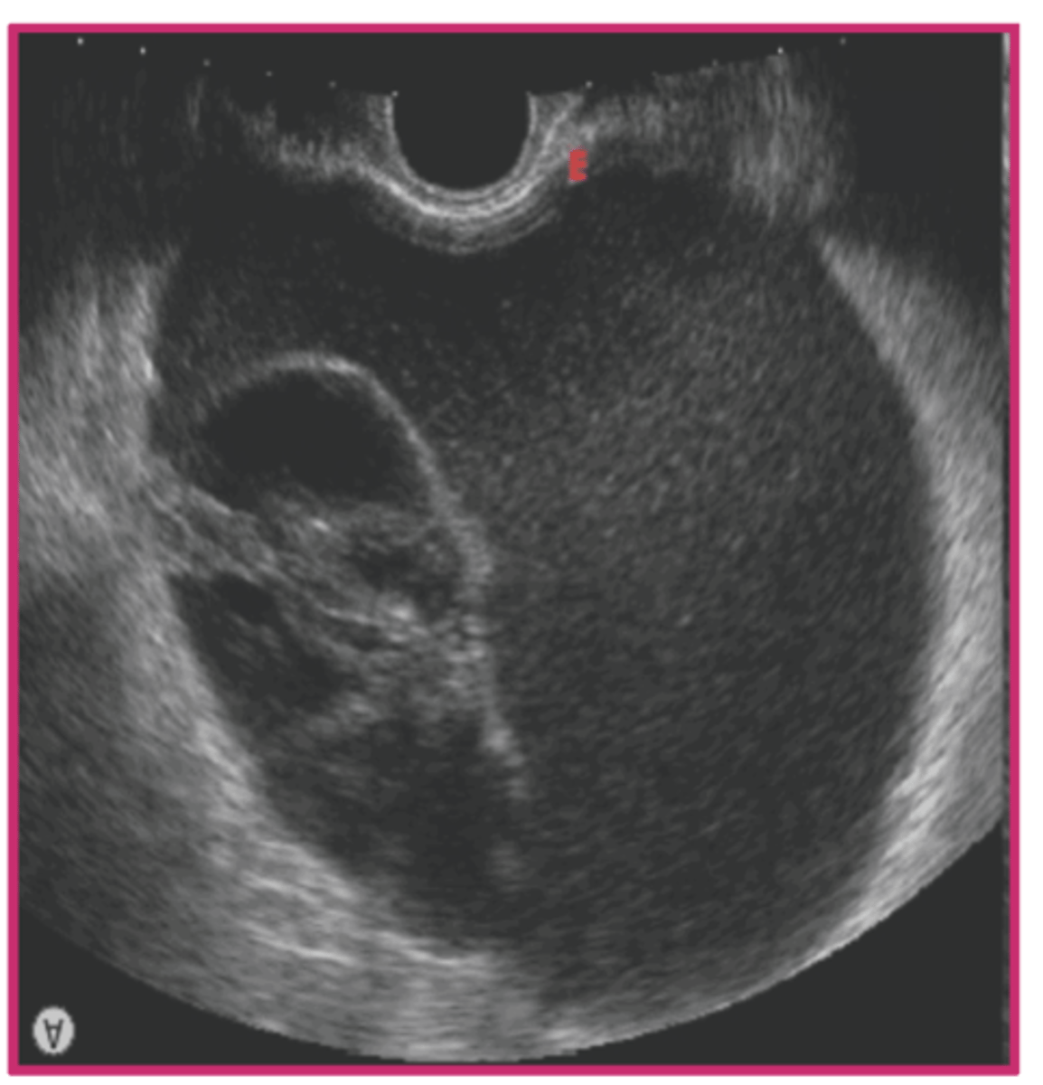 <p>endocervix; bowel</p>